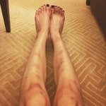 梁齊昕早前在Instagram貼出一張腿部受傷的照片／Photo Credit: Chai Yan Leung facebook