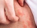 Eczema groin