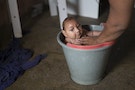 APTOPIX Brazil Zika Birth Defects