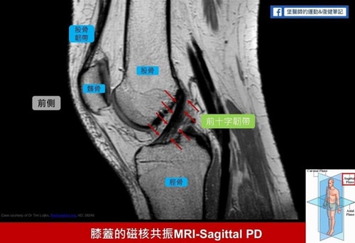 超音波 關節鏡 膝蓋軟骨磨損 5種檢查方式 哪個最重要 The News Lens 關鍵評論網