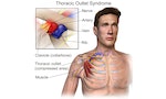 Thoracic_Outlet_Syndrome2