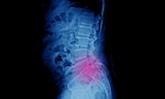 物理治療師談「脊椎滑脫」：當脊椎發生土石流時，該如何看待與預防？