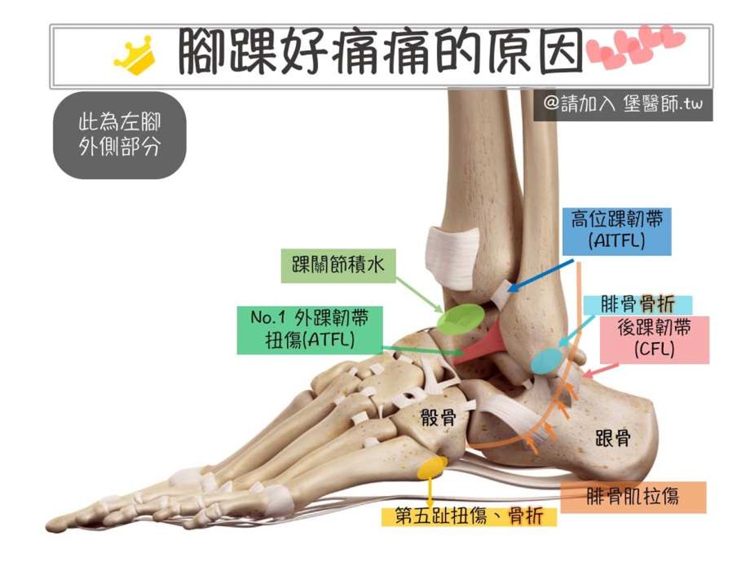 無論你的腳踝痛的是內外前後 這裡都有相對應的可能原因 The News Lens 關鍵評論網