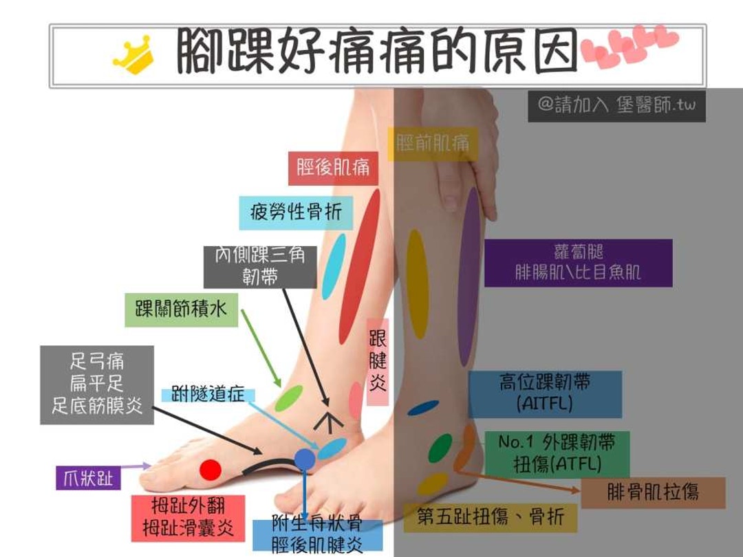 無論你的腳踝痛的是內外前後 這裡都有相對應的可能原因 The News Lens 關鍵評論網