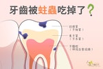 candy-and-tooth-caries-05-carries-tooth