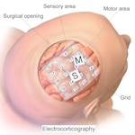 Intracranial_electrode_grid_for_electroc