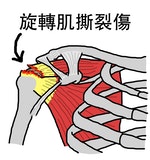 旋轉肌撕裂傷-棘上肌-拉傷-肩膀-肩關節