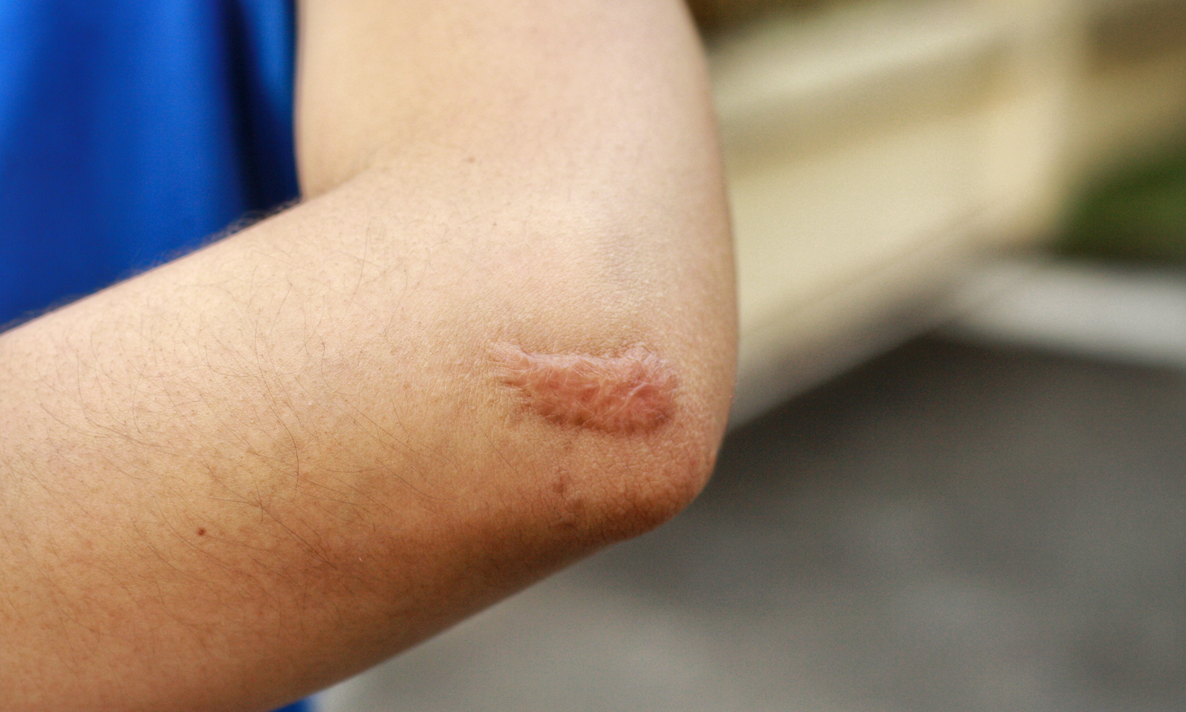 越長越大的疤：蟹足腫成因多與體質有關，如何預防和治療？ - The News