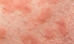 皮膚科醫師圖文解說「寒冷性蕁麻疹」：氣溫驟降，小心危「肌」重重！