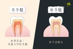 endo-whitening_heath-and-endo-tooth