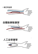 洗腎用自體動靜脈廔管與人工血管廔管示意圖_(1)