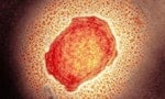 猴痘疫情：主要症狀有哪些？病毒如何傳播？如何治療？