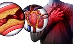 《預防猝死超圖解》：心絞痛與心肌梗塞合稱「缺血性心臟病」，兩者有什麼不同？