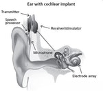 04-電子耳-cochlear-implant-web-pic