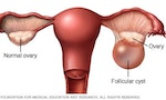 卵巢囊腫月經不來會導致不孕嗎？建議該如何治療？