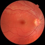 Fundus_photograph_of_normal_right_eye