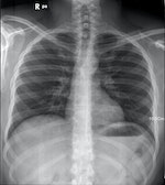 Chest_X-ray